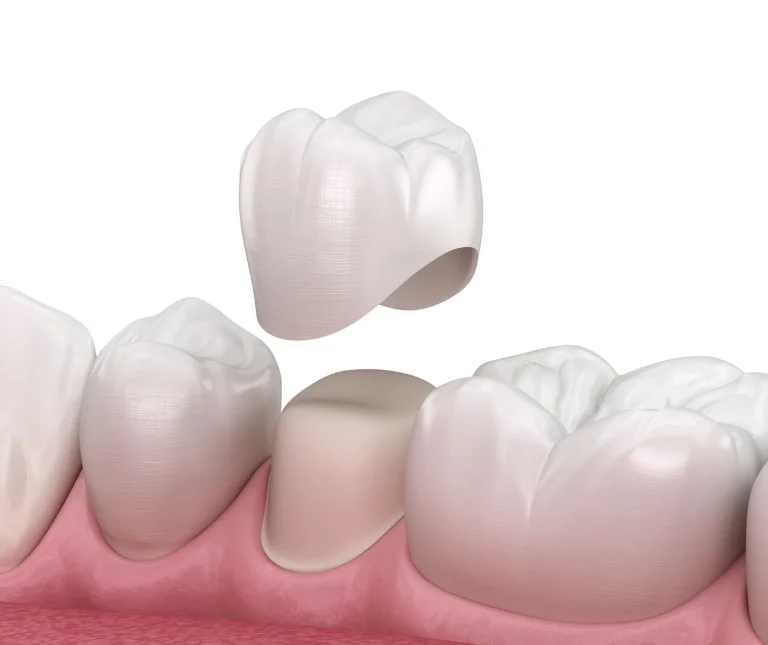 Dental Crowns