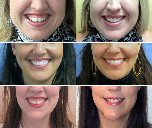 Gummy Smile Treatment: Reducing Excess Gum Visibility