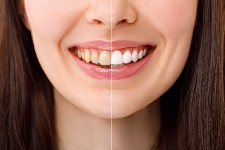 Understanding Dental X-Rays: How They Help Detect Hidden Oral Issues