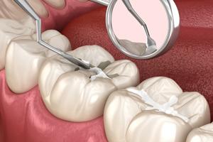 Modern Dental Impressions: How Technology is Improving Your Dental Experience