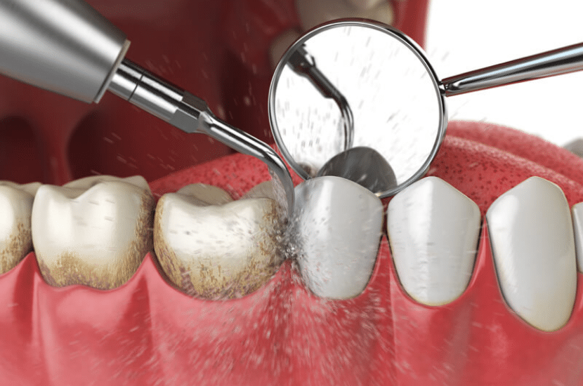 Gum Disease Treatment: How Periodontal Therapy Can Save Your Smile