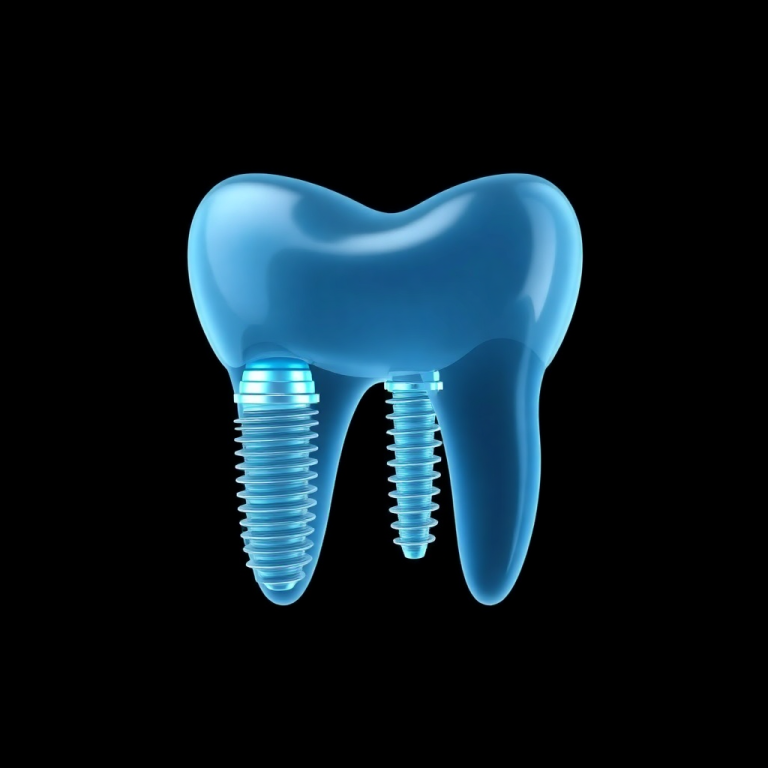 Dental Implants: A Solution for Missing Teeth
