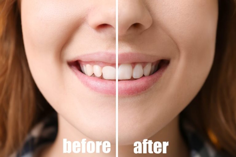 Gum Contouring: Reshaping the Gum Line for a Better Smile