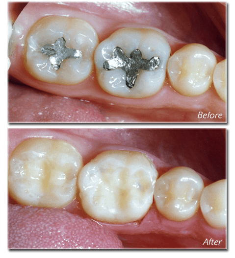 Composite Fillings: Aesthetic and Durable Tooth Restoration