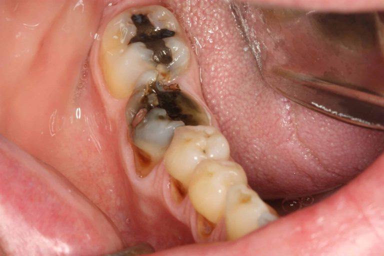 When Do You Need a Tooth Extraction? Signs, Procedures, and Recovery Tips