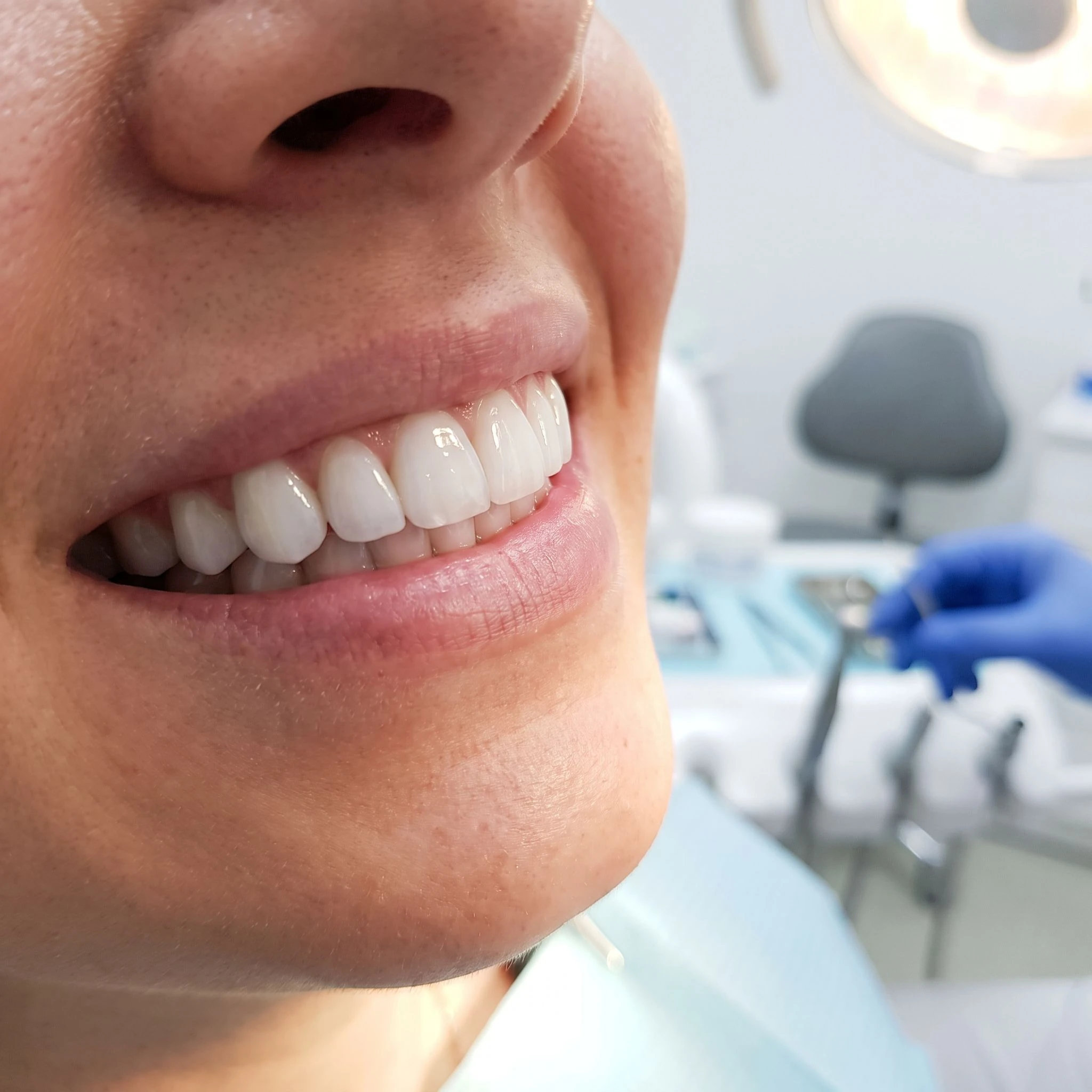 Essential Guide: What to Know Before Getting Veneers in Houston - cosmetic dentist